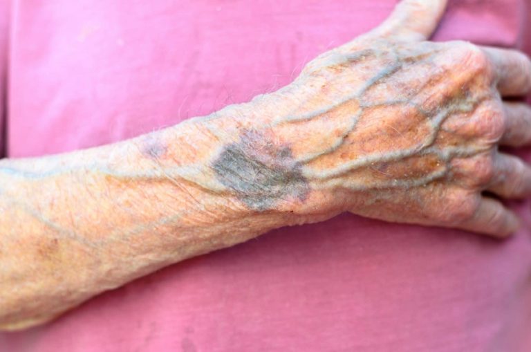 What Does Blue Veins Mean