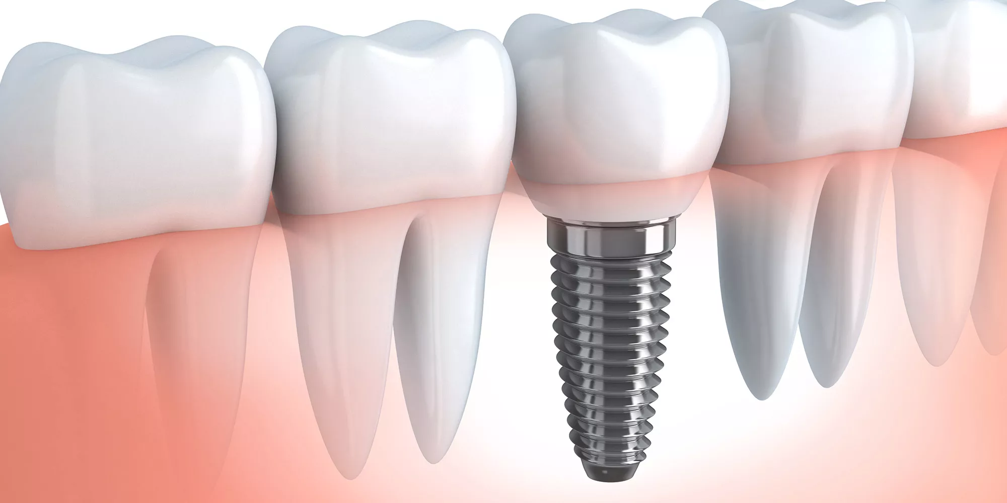 Understanding Dental Implants - Body Point For Me